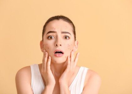 Obdobje pubertete in nadležne akne