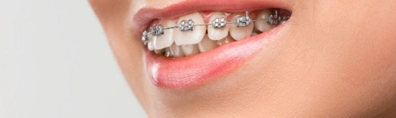 Retencija je zadnja faza ortodontskega zdravljenja